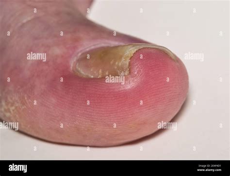 Ingrown Toenail Onychocryptosis On Caucasian Big Toe Hallux Caused By