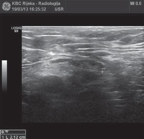 Ultrasound Image Of Reactive Axillary Lymph Node Download Scientific