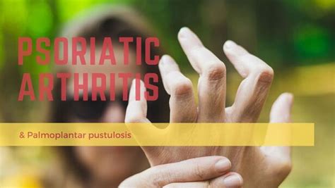 Palmoplantar Pustulosis Blog Symptoms And Treatments