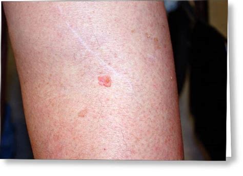 Skin Cancer On Lower Leg