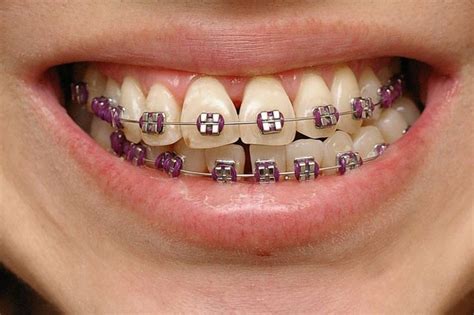 Incredible What Is The Best Color For Braces Quiz Ideas