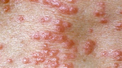Contagious Skin Disease Pictures Photos
