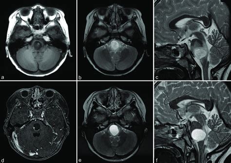Preoperative Magnetic Resonance Mr Images A T1 Weighted Image