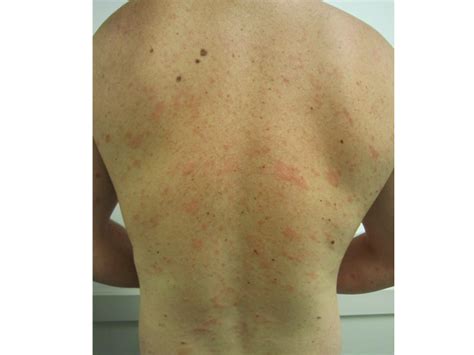 Pityriasis Rosea Christmas Tree