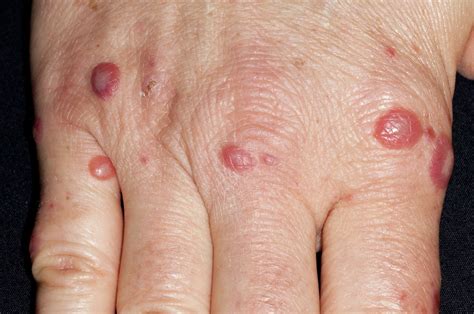 Adults With Hand Foot And Mouth Disease Review And Case Study