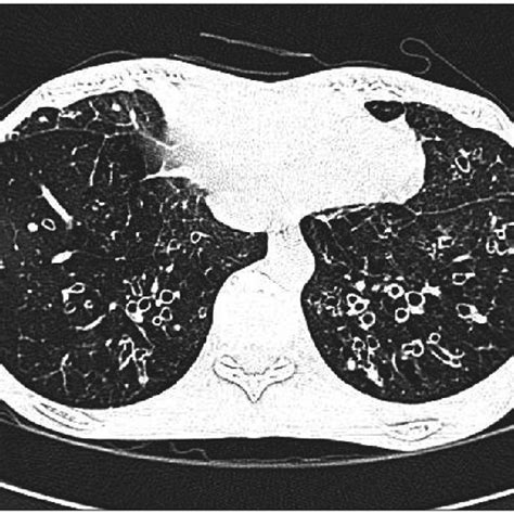 High Resolution CT Of The Chest Showing The Recurred Subcutaneous