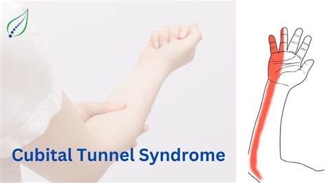Cubital Tunnel Syndrome Symptoms Causes And Treatments Best Back Pain