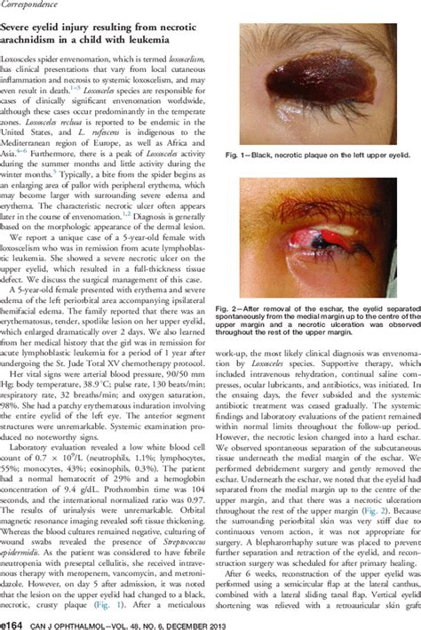 Severe Eyelid Injury Resulting From Necrotic Arachnidism In A Child