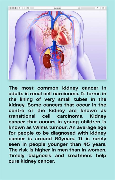 Ppt General Facts About Kidney Cancer Urologists Rescue Hospital