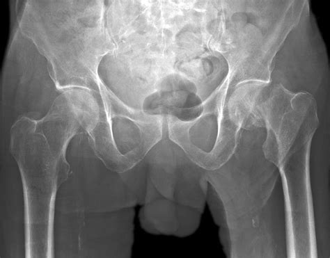 Broken Hip X Ray Photograph By Du Cane Medical Imaging Ltd Pixels