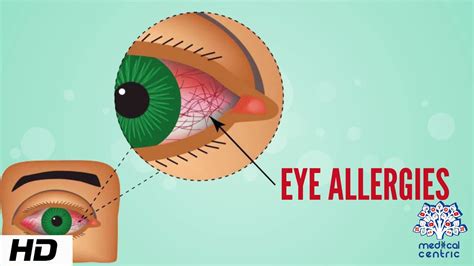 Eye Allergy Causes Signs And Symptoms Diagnosis And Treatment Youtube