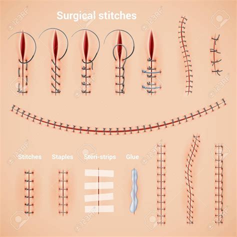 Surgical Suture Stitches Realistic Set Of Stitching Methods And Shapes
