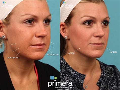 Face Fat Removal Outlet Discounts Save 40 Jlcatjgobmx