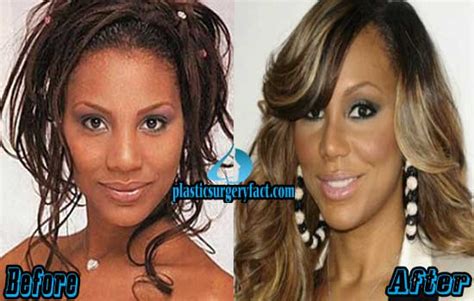 Tamar Braxton Plastic Surgery Before And After Photos Plastic Surgery