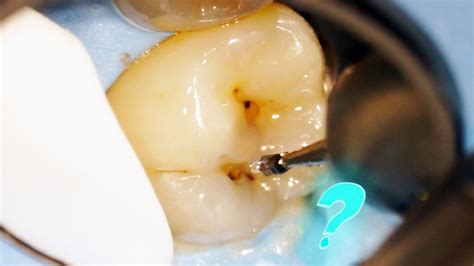 What Lies Beneath That Dark Spot On Your Tooth Youtube
