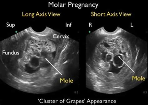 Molar Pregnancy Hydatidiform Mole Causes Symptoms Treatment