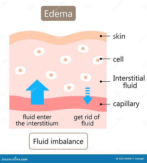 Diagram Of Edema And Normal Skin Swelling Is Caused By Excess Fluid