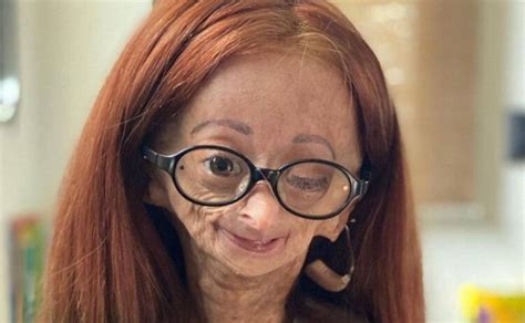 Muere A Los 15 Años Adalia Rose Williams La Youtuber Que Inspiró La Película De Benjamin Button