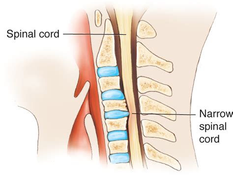 Neck And Cervical Spine Injuries Musculoskeletal Key