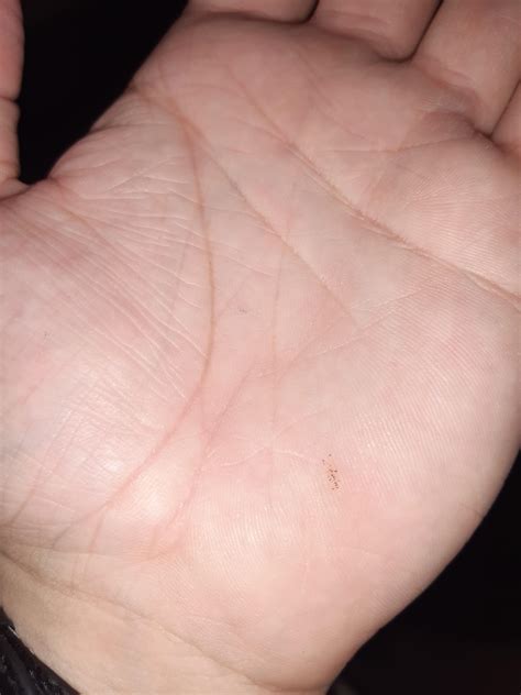 i have had these black dots on the palm of my hand for a few weeks could anyone please advise