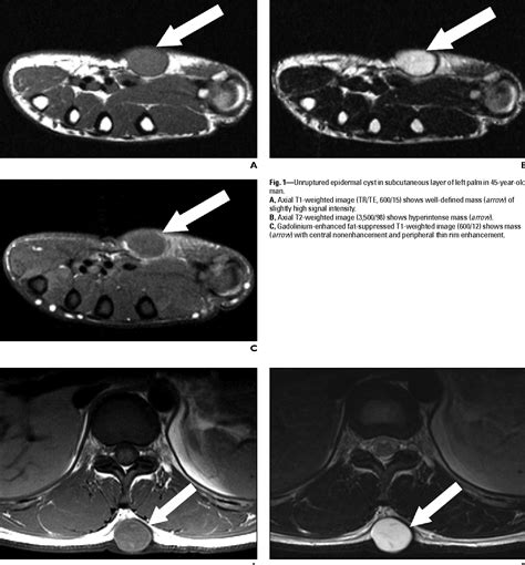 Figure 1 From Mri Findings Of Subcutaneous Epidermal Cysts Emphasis On