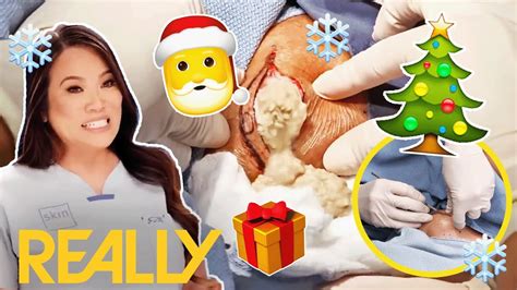 Dr Lees Most Intense Cyst And Bump Removals With Christmas Music Dr