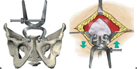 Diastasis Of The Symphysis Pubis Open Reduction Internal Fixation