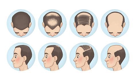 Male Pattern Baldness Faqs And Treatment