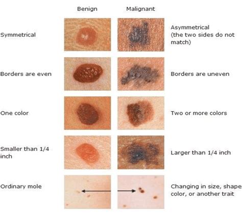 1 Benign Vs Malignant Melanoma Download Scientific Diagram