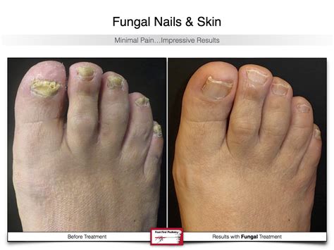 Top Nail Fungus Before And After Pictures Architectures Eric