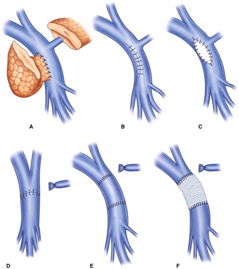 Venous Reconstruction In Oncologic Surgery Thoracic Key