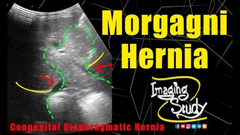 Morgagni Hernia Congenital Diaphragmatic Hernia Ultrasound