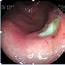 How To See Peptic Ulcer In Endoscopy  From A Clinicians Bioscope