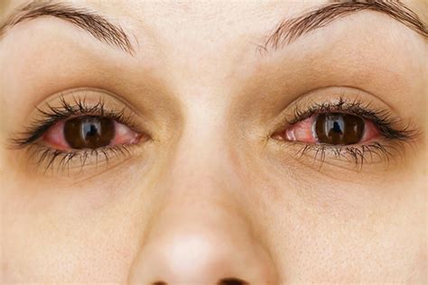 What Causes Red Eyes And What It Means Faze