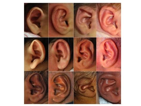 Nonsurgical Procedure Quickly And Effectively Corrects Newborn Ear