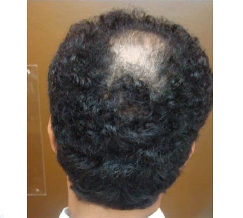 What Is Diffuse Patterned Alopecia Dpa And Its Treatment Hair