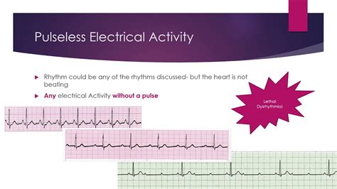 Ecg Ventricular Rhythms Premature Beats And Lethal Voiceover Youtube
