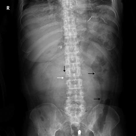 Radiographic Findings Of A Ruptured Abdominal Aortic Aneurysm Circulation