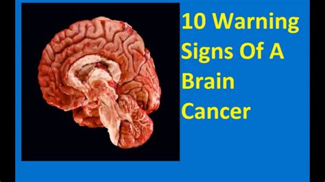 Stage 4 Brain Cancer Life Expectancy Page Design Web