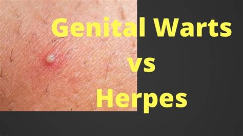 Hpv Vs Genital Warts