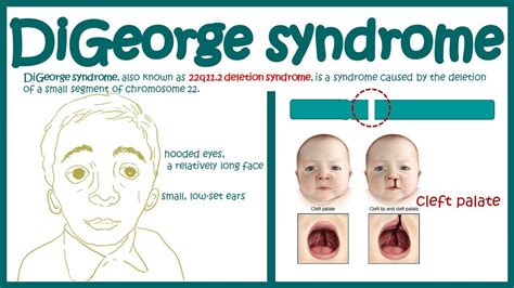 Digeorge Syndrome Facial Features Telegraph