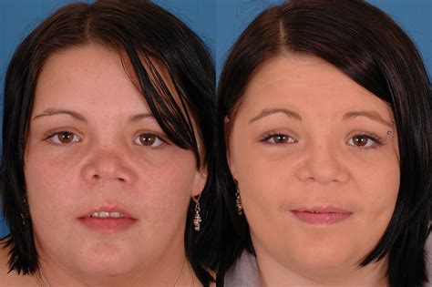 Revision Rhinoplasty 6 Dallas Advanced Facial Plastic Surgery Center