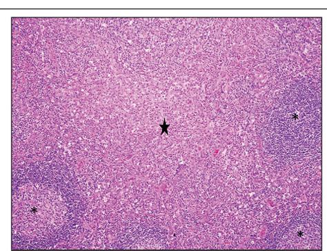 Figure 1 From Kimura′s Disease Of Head And Neck A Rare Case