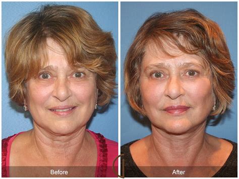 Facial Fat Grafting Newport Beach Fat Transfer Dr Kevin Sadati