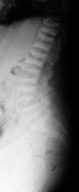 Renal Osteodystrophy Radiology Reference Article Radiopaedia Org