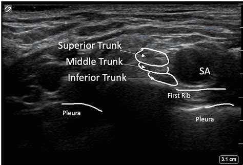 Cureus Comparison Of Supraclavicular Regional Nerve Block Versus