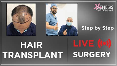 Live Hair Transplant Surgery Indore हयर टरसपलट सरजर इदर