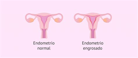 Qu Es La Hiperplasia Endometrial Y Por Qu Se Produce