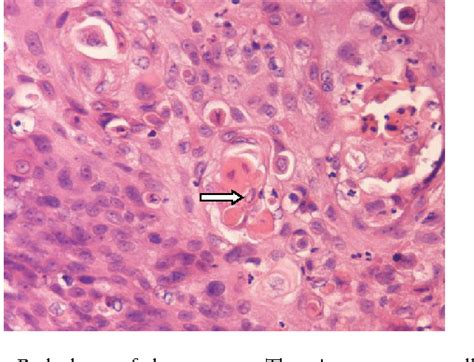 Figure 4 From Thyroid Carcinoma Showing Thymic Like Differentiation