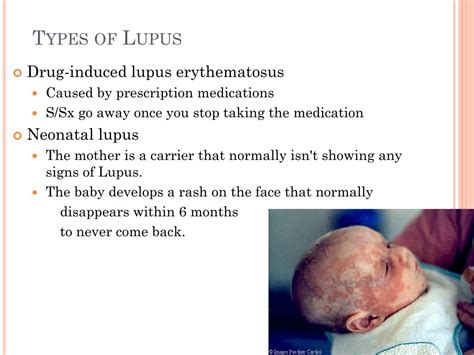 Ppt Lupus Powerpoint Presentation Free Download Id2088612
